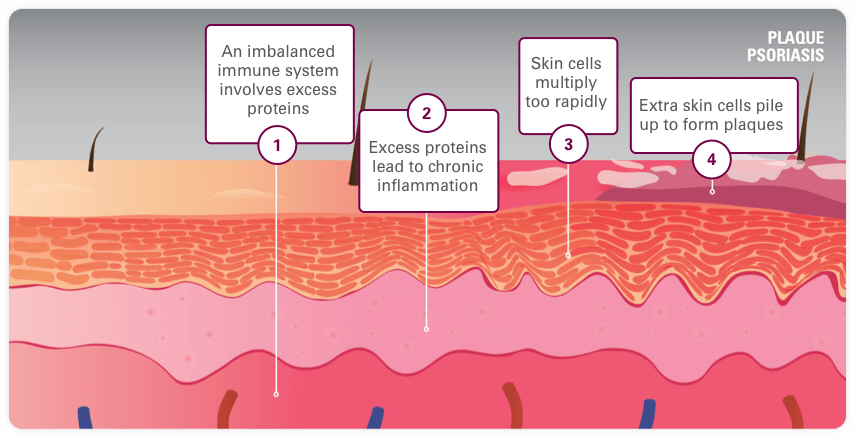 Image of Plaque Psoriasis Skin Layers