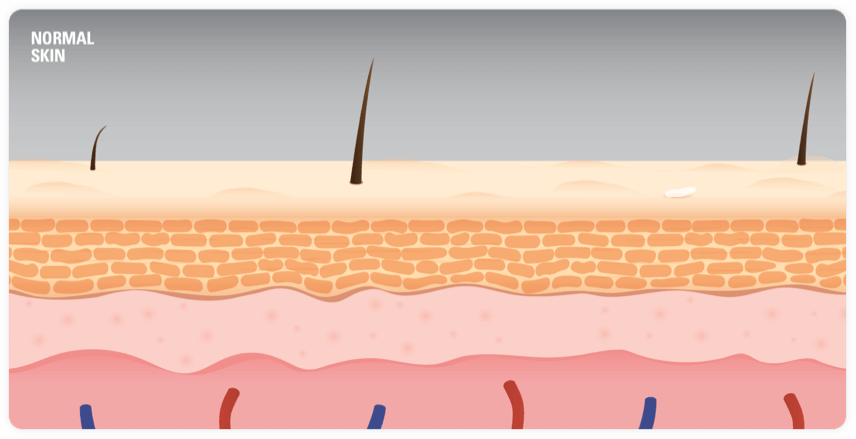 Image of Plaque Psoriasis Skin Layers