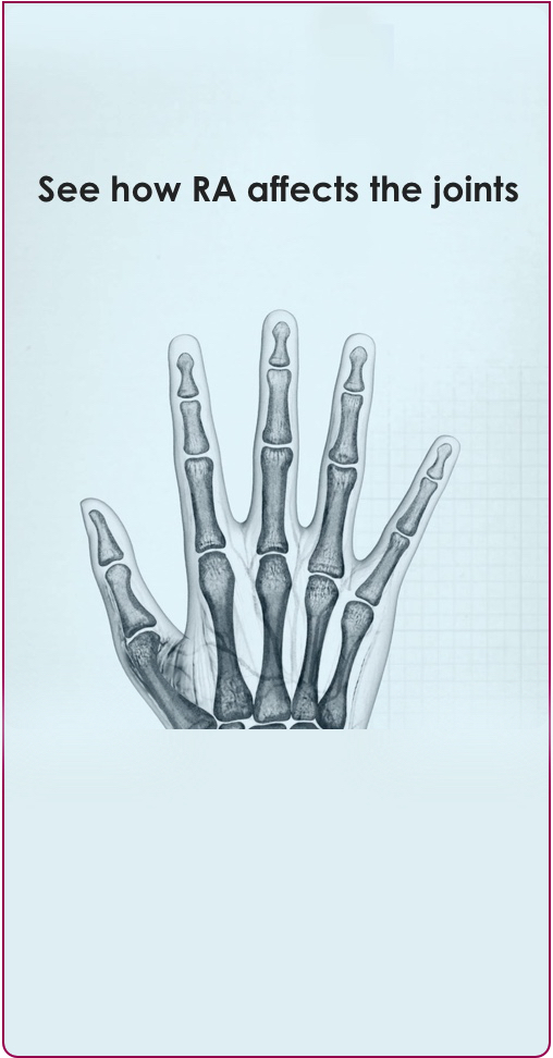 RA affecting the joints of a healthy hand