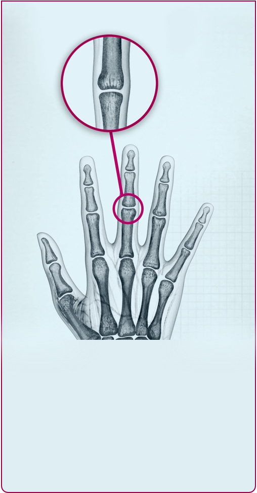 Joints of a hand affected by Stage 1 RA