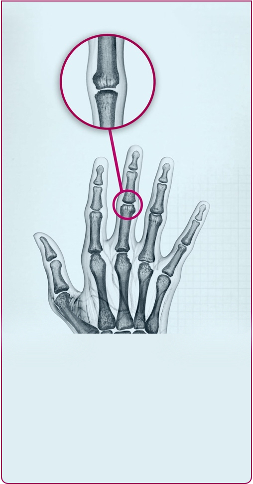 Joints of a hand affected by Stage 2 RA