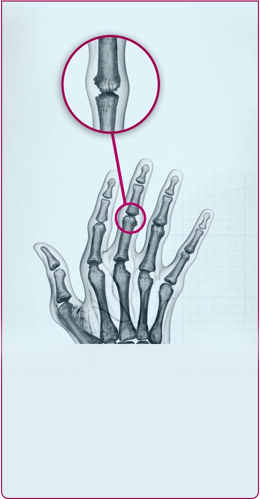 Joints of a hand affected by Stage 3 RA