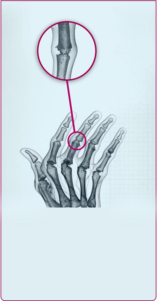 Joints of a hand affected by Stage 4 RA